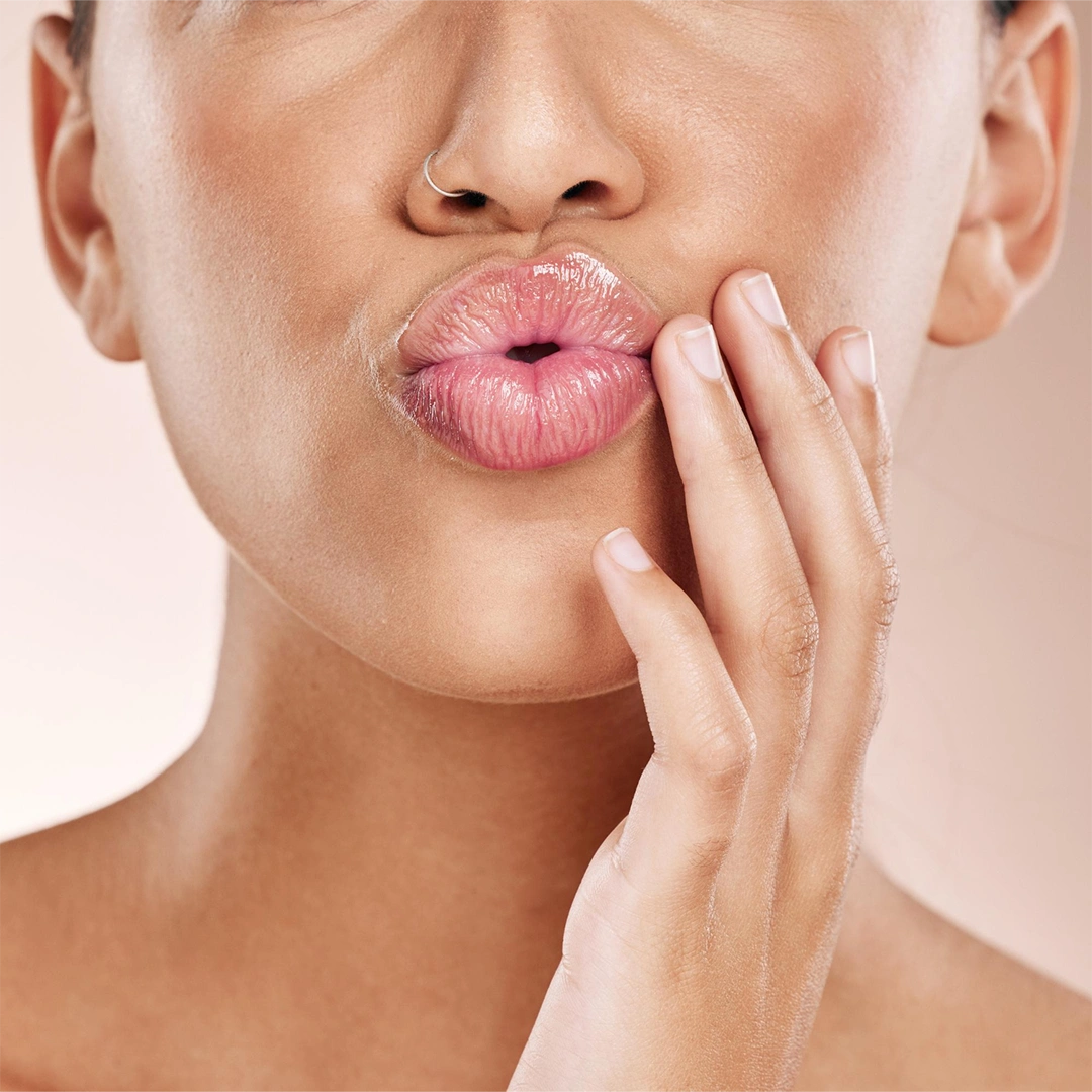 Procedimento de preenchimento labial realizado por Luciana Simone para realce e volume dos lábios